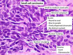 Histopathology of small-cell carcinoma, with typical findings.