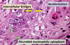 Squamous cell carcinoma with typical histopathology features.