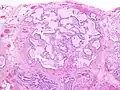 Appearance of honeycomb change in a surgical lung biopsy at low magnification. The dilated spaces seen here are filled with mucin. Hematoxylin-eosin stain, low magnification.