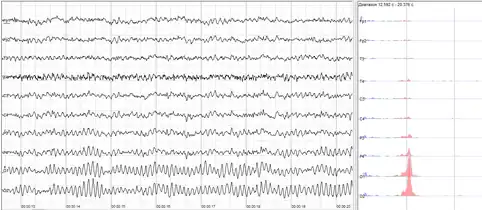 Human EEG with prominent resting state activity – alpha-rhythm. Left: EEG traces (horizontal – time in seconds; vertical – amplitudes, scale 100 μV). Right: power spectra of shown signals (vertical lines – 10 and 20 Hz, scale is linear). Alpha-rhythm consists of sinusoidal-like waves with frequencies in 8–12 Hz range (11 Hz in this case) more prominent in posterior sites. Alpha range is red at power spectrum graph.