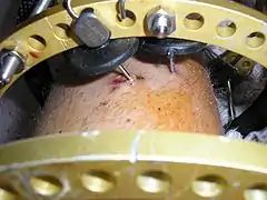 Superior perspective of the Ilizarov apparatus and the Kirschner pins in the left leg at two weeks post-surgical.