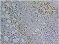 Immunohistochemical staining of trophozoites (brown) using specific anti–Entamoeba histolytica macrophage migration inhibitory factor antibodies in a patient with amebic colitis.