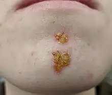 Impetigo