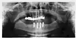 Panorex radiograph showing implants