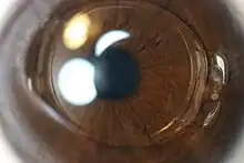 Anterior chamber IOL