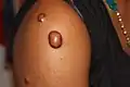 Keloid nodules (1–2 cm in diameter) and a keloid tumor >2 cm in diameter