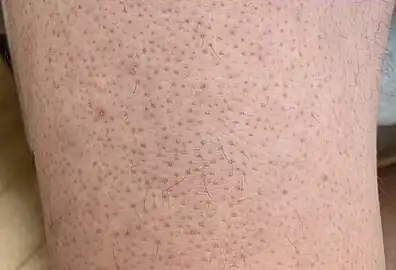 Keratosis pilaris on lower extremity