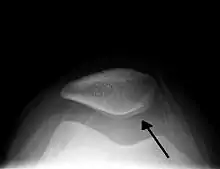 Skyline view of the patella demonstrating a large joint effusion as marked by the arrow.