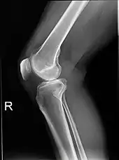 Knee X-ray