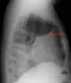 A pleural effusion as seen on lateral upright chest x-ray