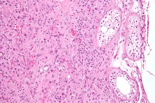 Micrograph of a Leydig cell tumour