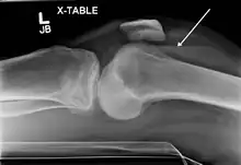 Lipohemarthrosis (presence of fat and blood from bone marrow in the joint space after an intraarticular fracture) seen on X-ray in a person with a subtle tibial plateau fracture