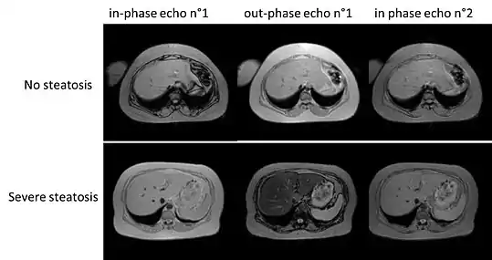 Liver steatosis (fatty liver disease) as seen on MRI. Multiecho MR sequence in a healthy liver (top row) and a liver with severe steatosis (bottom row) are shown. In the healthy liver, the signal does not vary much in the different echoes. In the steatotic liver, the signal varies greatly between in and out phase echoes. Algebraic combination of these images can be used to accurately quantify liver steatosis.