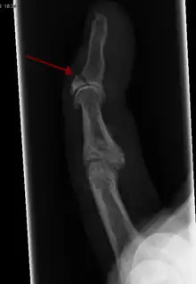 X-ray showing fracture at the insertion of the extensor tendon