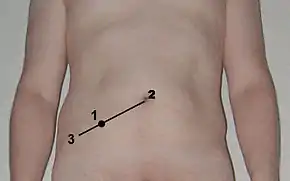 Location of McBurney's point (1), which is located two thirds the distance from the umbilicus (2) to the anterior superior iliac spine (3)