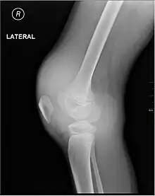 X-ray of Hemarthrosis