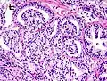 Gleason score 8 (4+4) with glomeruloid glands