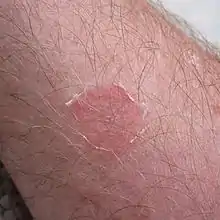 Circular red skin lesion surrounded by skin scale.