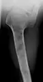 X-ray showing enchondromas localized in the humerus of a 37-year-old patient affected with Ollier disease