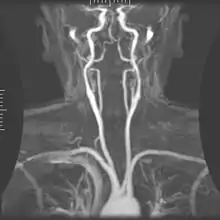 Magnetic resonance angiography