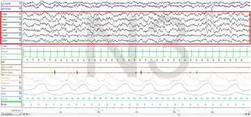 Stage 3 Sleep. EEG highlighted by red box.