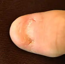 Big toe with most of the toenail missing; only the nail's root is present