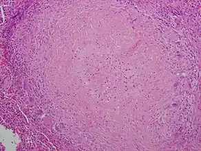 Granuloma with central necrosis in a lung of a person with tuberculosis: Note the Langhans-type giant cells (with many nuclei arranged in a horseshoe-like pattern at the edge of the cell) around the periphery of the granuloma. Langhans-type giant cells are seen in many types of granulomas and are not specific for tuberculosis.