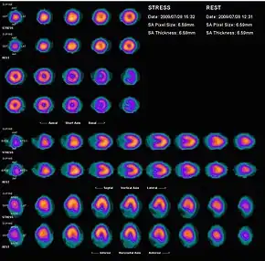 Nuclear medicine myocardial perfusion scan with thallium-201 for the rest images (bottom rows) and Tc-Sestamibi for the stress images (top rows). The nuclear medicine myocardial perfusion scan plays a pivotal role in the non-invasive evaluation of coronary artery disease. The study not only identifies patients with coronary artery disease; it also provides overall prognostic information or overall risk of adverse cardiac events for the patient.