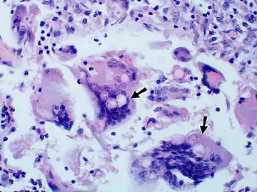 Large yeast-like fungi seen within giant cells at arrows. Budding yeasts in cytoplasm of giant cells at arrows. Broad-based budding and double contoured cell wall seen in the giant cell in the center is characteristic of Blastomyces dermatitidis.