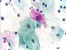 An obviously atypical cell can be seen