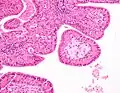 High magnification micrograph of a Warthin tumor showing the characteristic bilayered epithelium.