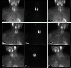 A nuclear medicine parathyroid scan demonstrates a parathyroid adenoma adjacent to the left inferior pole of the thyroid gland. The above study was performed with Technetium-Sestamibi (1st column) and iodine-123 (2nd column) simultaneous imaging and the subtraction technique (3rd column).