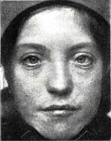 Patient with Waardenburg Syndrom III (Waardenburg-Klein Syndrome)