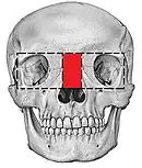 Box osteotomy