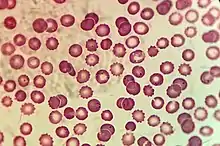 Microscopic view of Plasmodium in Erythrocytes