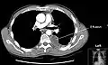 CT scan of the chest showing a left-sided pleural effusion. The fluid usually settles at the lowest space due to gravity; in this case, at the back because the patient is supine.