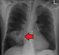 Pulmonary abscess on CXR