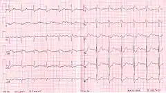 RBBB with associated first degree AV block