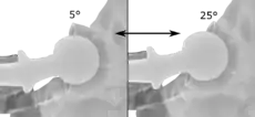 Acetabular anteversion is normally between 5 and 25°. An anteversion below or above this range increases the risk of dislocation. There is an intra-individual variability in this method because the pelvis may be tilted in various degrees in relation to the transverse plane.