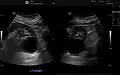 Renal cyst as seen on abdominal ultrasound