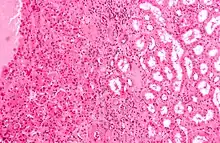 Micrograph of a renal oncocytoma. H&E stain.