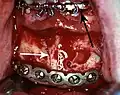 Rigid internal fixation of parasymphysis fracture of the mandible.  White arrow marks fracture, black arrow marks arch bar on lower teeth