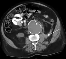 A ruptured AAA with an open arrow marking the aneurysm and the closed arrow marking the free blood in the abdomen