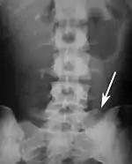 Sacralization of the L5 vertebra is seen at the lower right of the image.