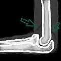 A schematic drawing showing the sail sign which represents an effusion.