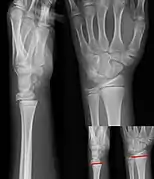 Salter–Harris I fracture of distal radius.