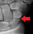 A more obvious scaphoid fracture on a scaphoid view X ray