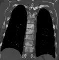 Sclerosis of the bones of the thoracic spine due to prostate cancer metastases (CT image)