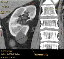 Simple renal cyst.jpg