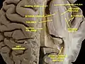 Ventricles of brain and basal ganglia.Superior view. Horizontal section. Deep dissection.